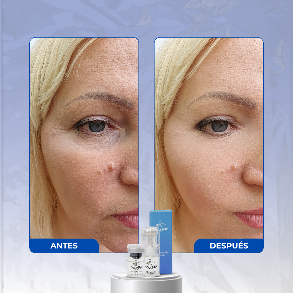 NovaPiel ReVive – Sistema de Microinfusión Facial Avanzada