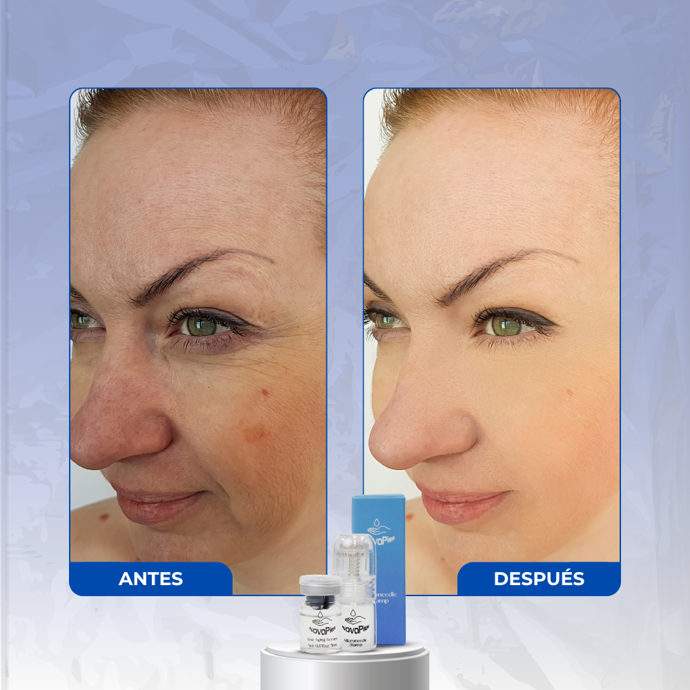NovaPiel ReVive – Sistema de Microinfusión Facial Avanzada