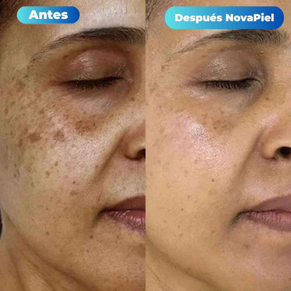 Tratamiento de Microinfusión NovaPiel