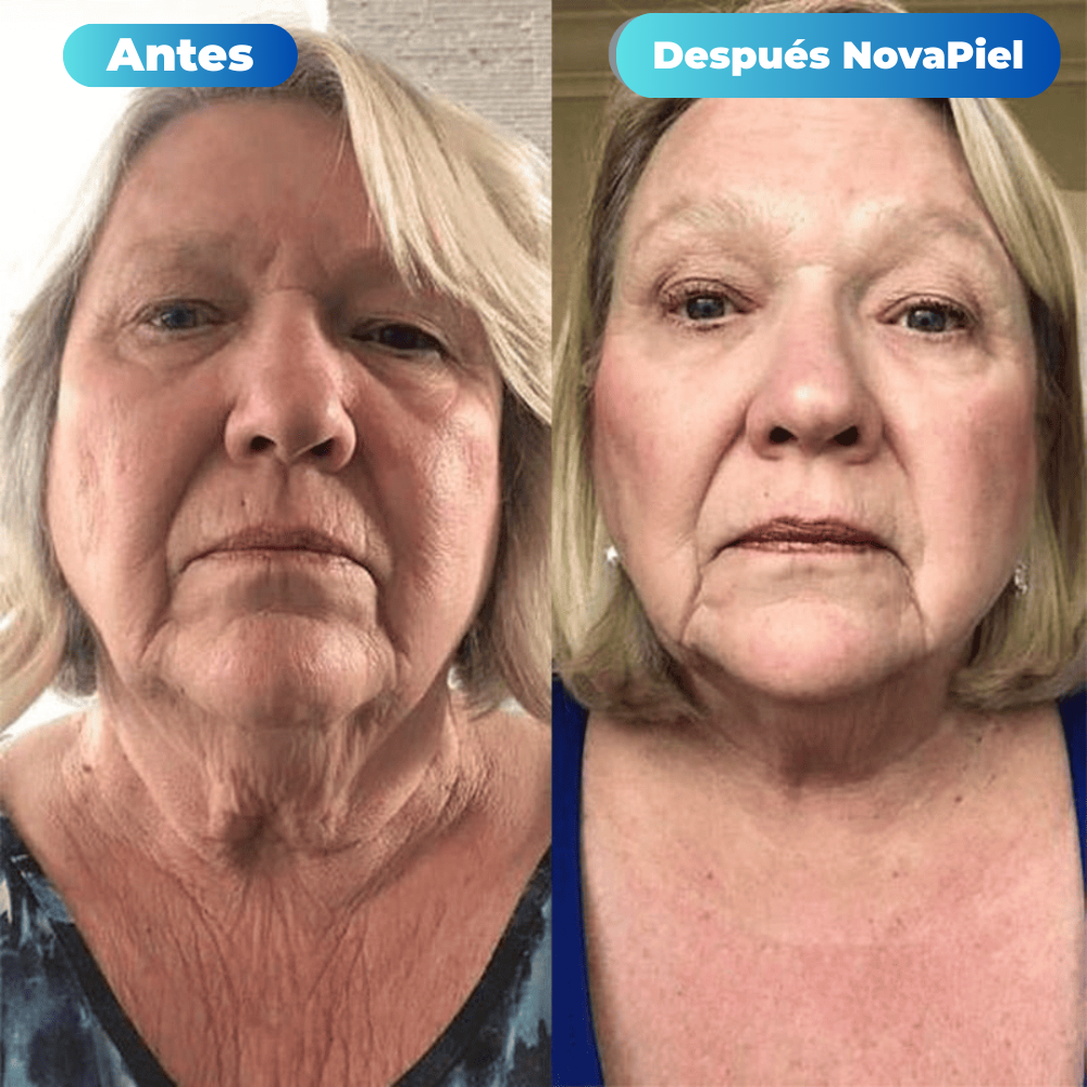 Tratamiento de Microinfusión NovaPiel