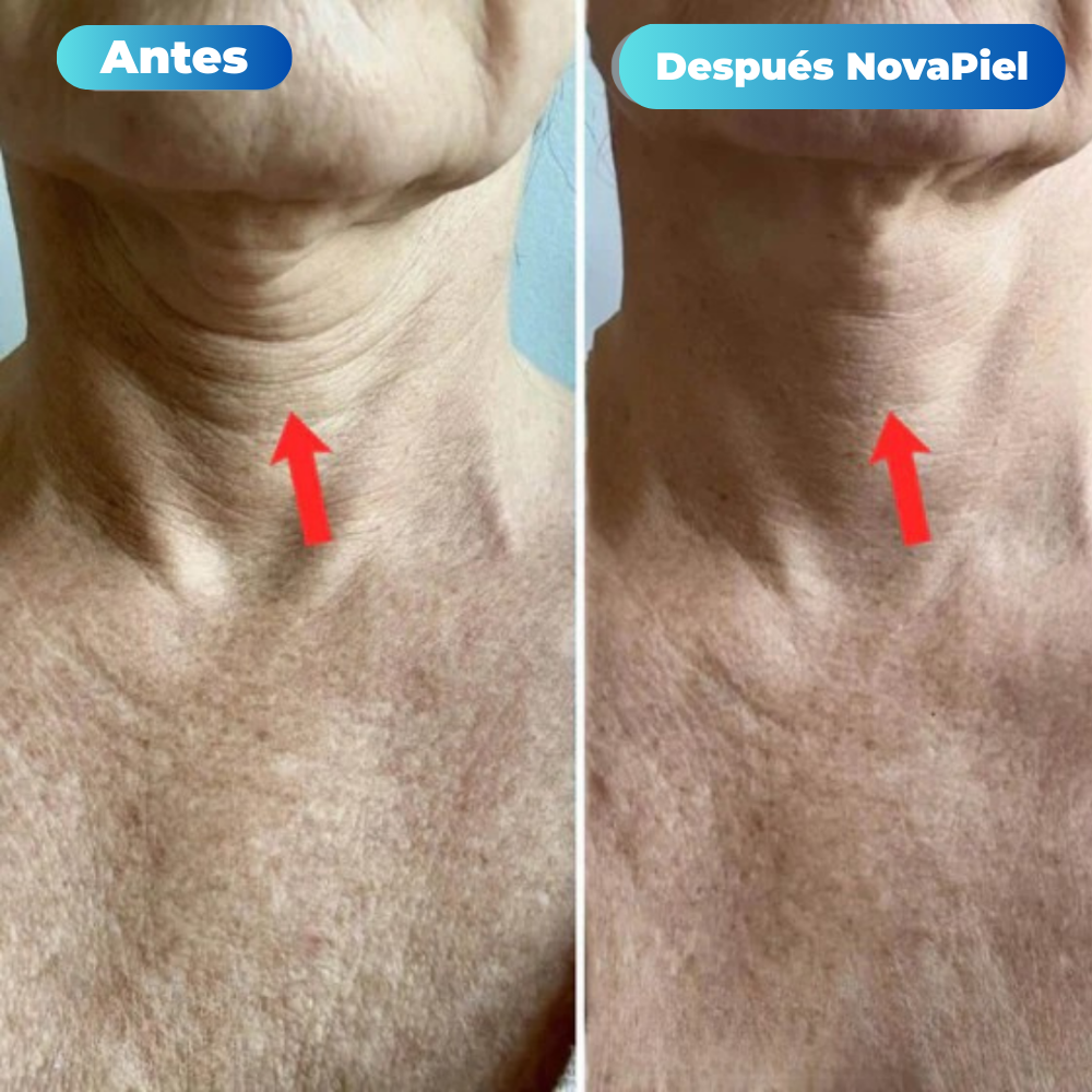 Tratamiento de Microinfusión NovaPiel