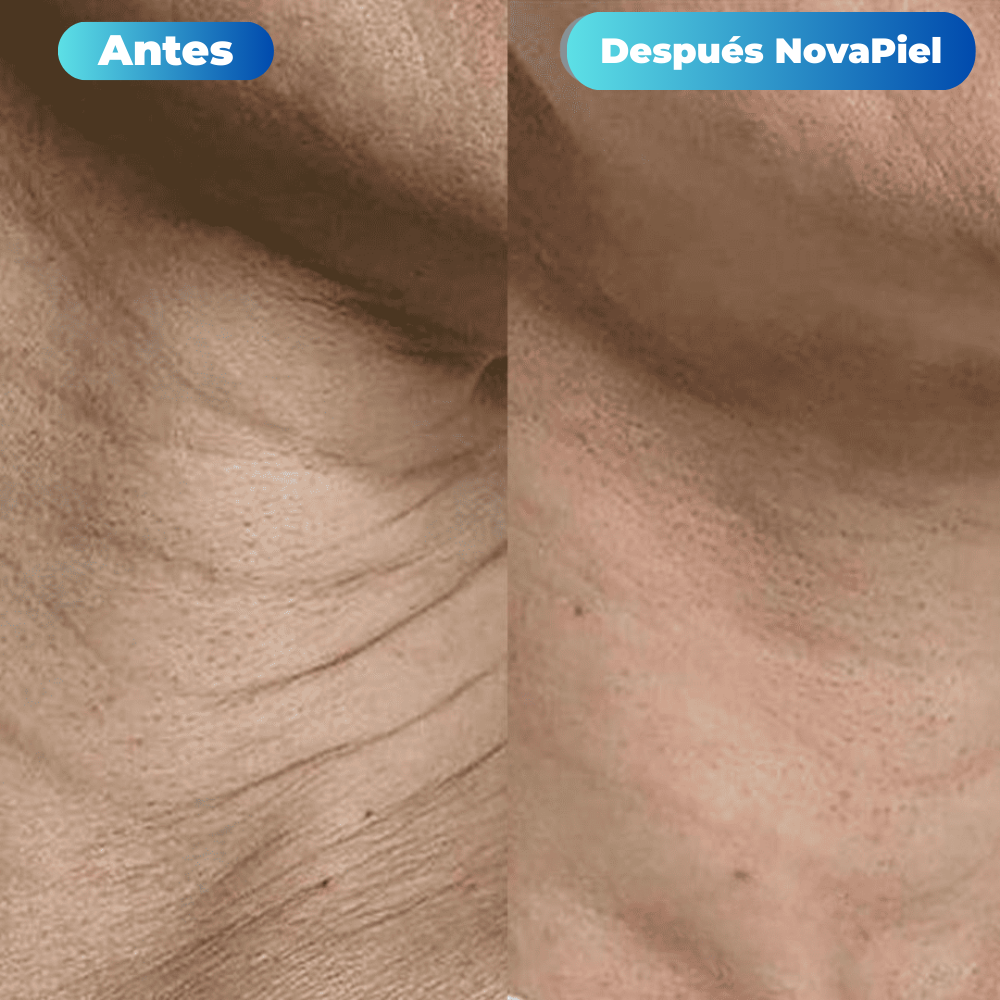 Tratamiento de Microinfusión NovaPiel
