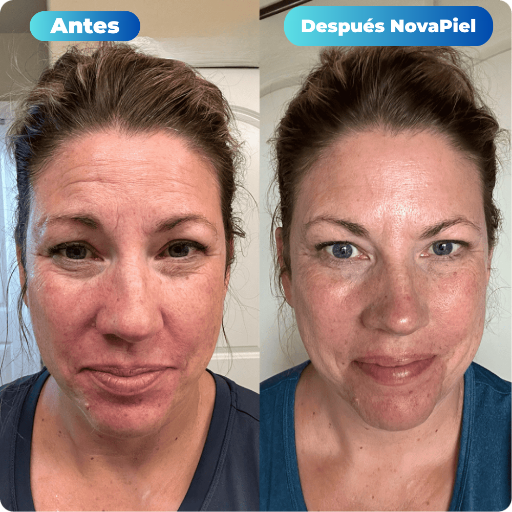 Tratamiento de Microinfusión NovaPiel