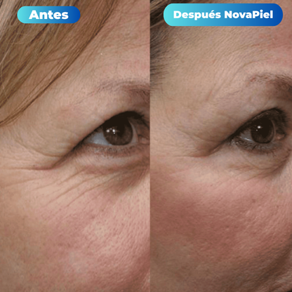 Tratamiento de Microinfusión NovaPiel